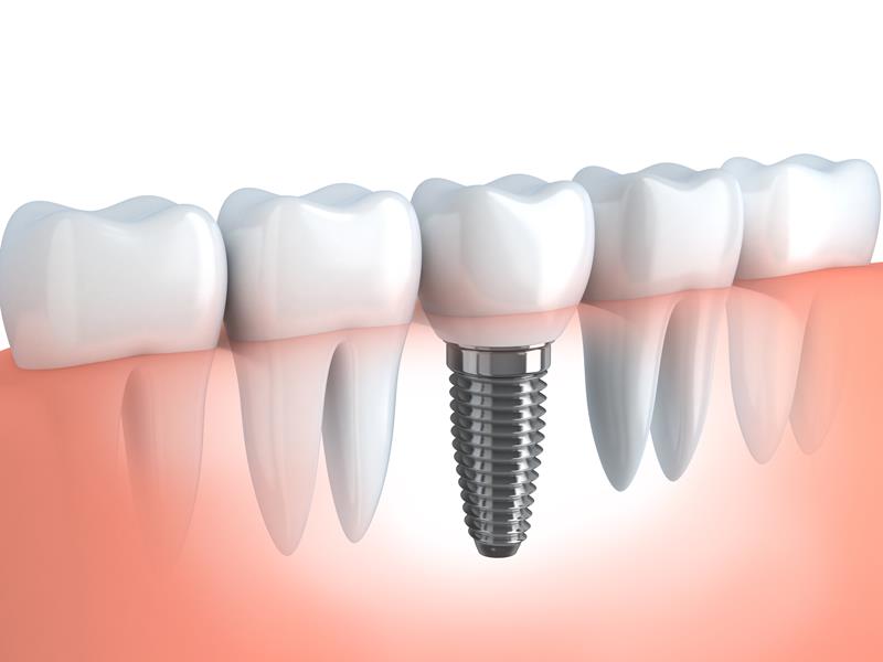 Dental Implants Hopatcong, NJ