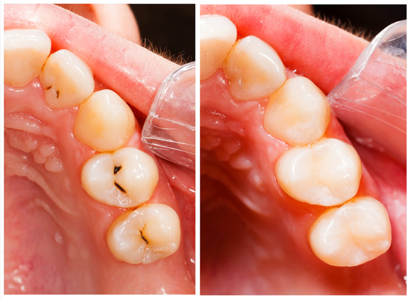 Fillings  Hopatcong, NJ