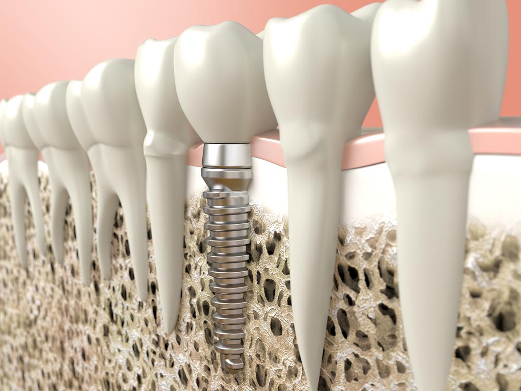 Dental Implants  Hopatcong, NJ