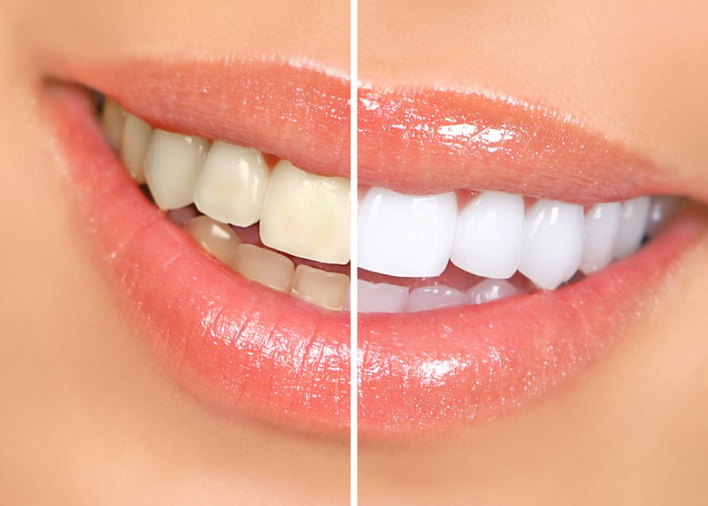 Teeth Whitening  Hopatcong, NJ